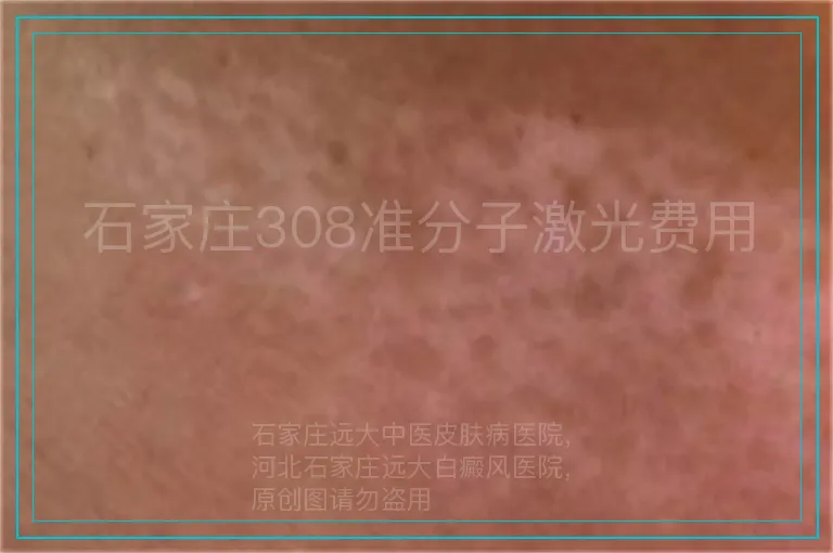 石家庄308准分子激光费用