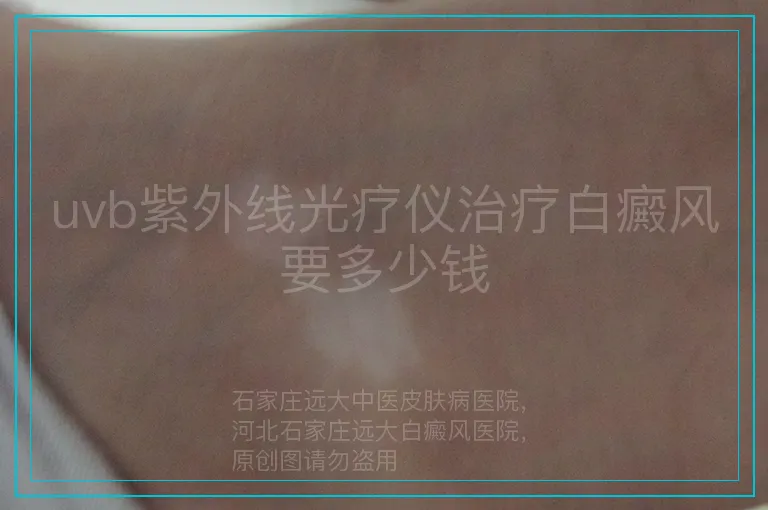 uvb紫外线光疗仪治疗白癜风要多少钱