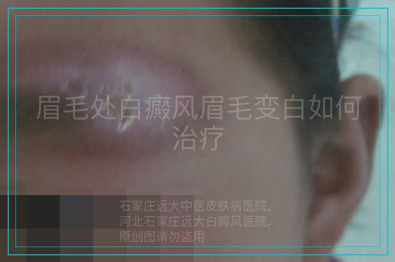 眉毛处白癜风眉毛变白如何治疗