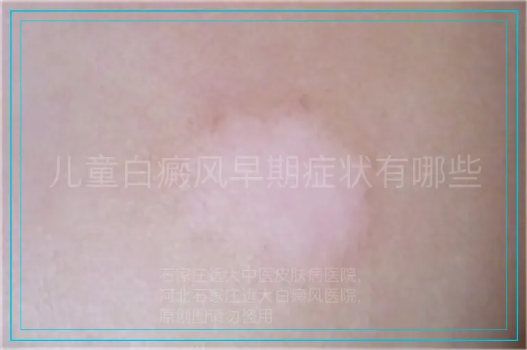 儿童白癜风早期症状有哪些