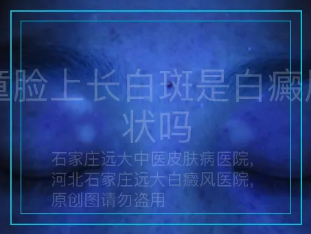 儿童脸上长白斑是白癜风症状吗