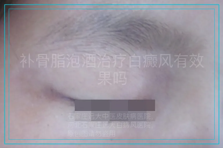 补骨脂泡酒治疗白癜风有效果吗