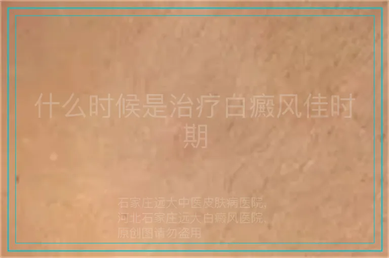 什么时候是治疗白癜风佳时期