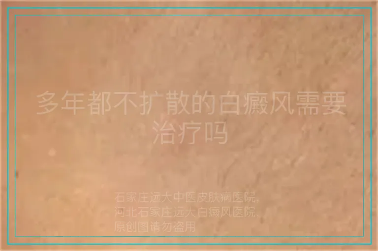 多年都不扩散的白癜风需要治疗吗