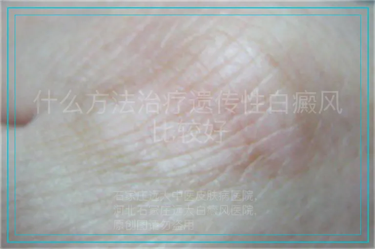 什么方法治疗遗传性白癜风比较好