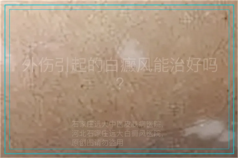 外伤引起的白癜风能治好吗?