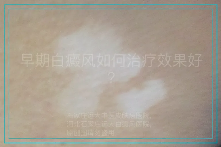 早期白癜风如何治疗效果好?