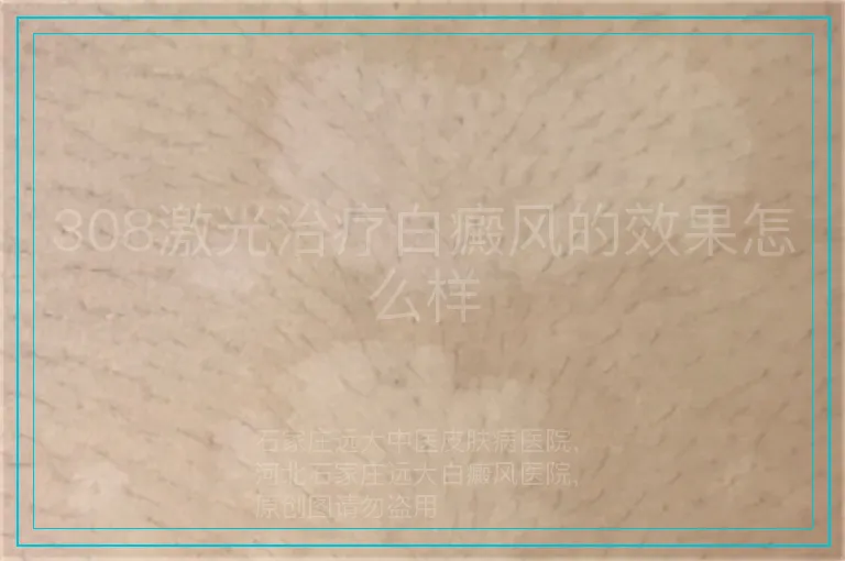 308激光治疗白癜风的效果怎么样