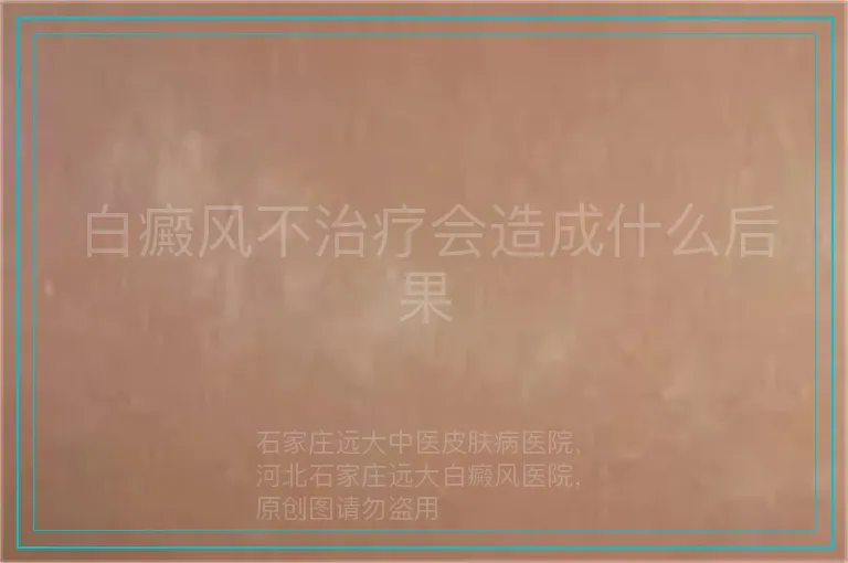 白癜风不治疗会造成什么后果