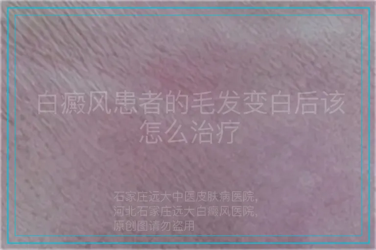 白癜风患者的毛发变白后该怎么治疗