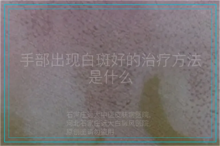 手部出现白斑好的治疗方法是什么