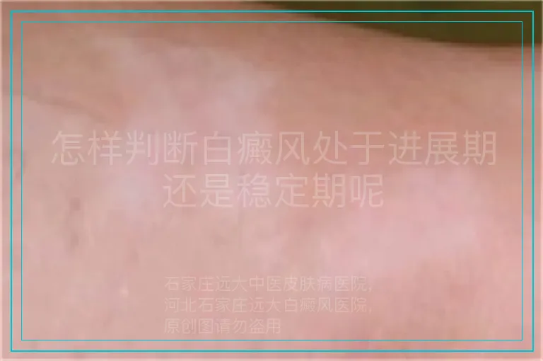 怎样判断白癜风处于进展期还是稳定期呢
