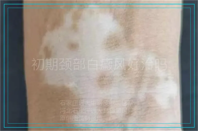 初期颈部白癜风好治吗