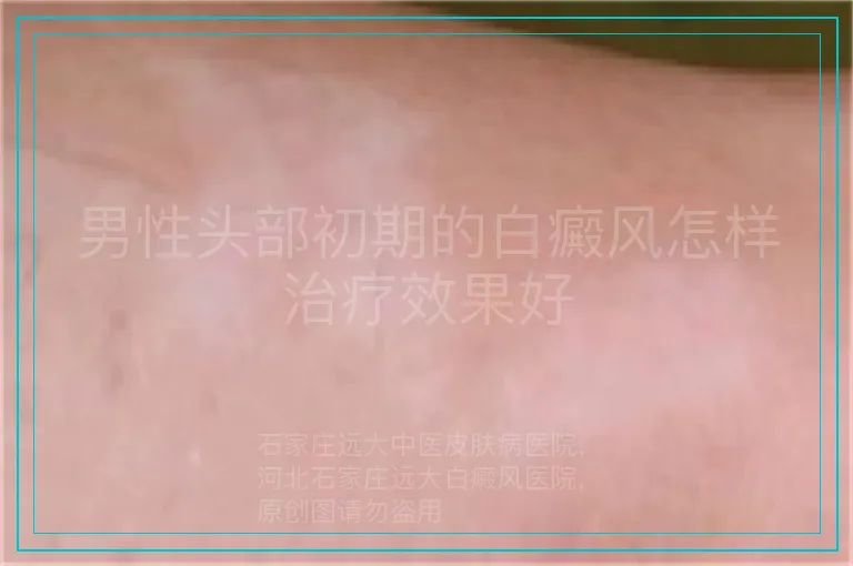 男性头部初期的白癜风怎样治疗效果好