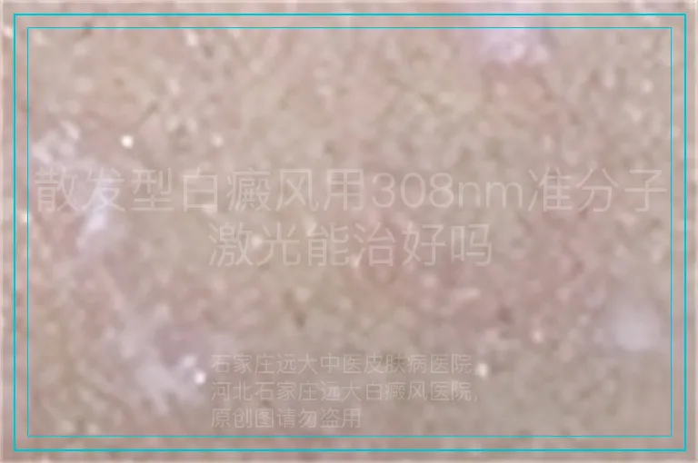 散发型白癜风用308nm准分子激光能治好吗