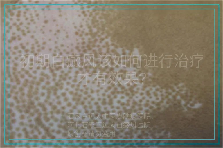 初期白癜风该如何进行治疗才有效果?