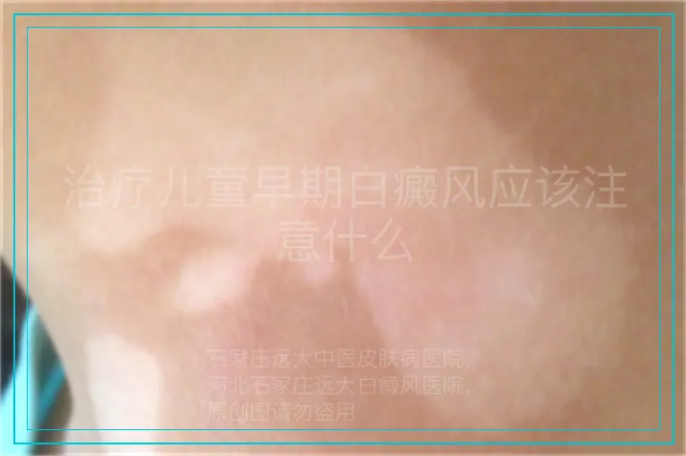 治疗儿童早期白癜风应该注意什么
