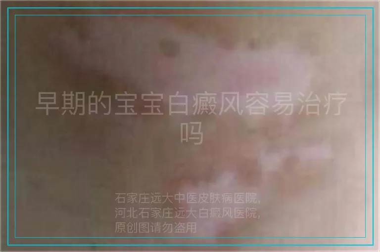 早期的宝宝白癜风容易治疗吗