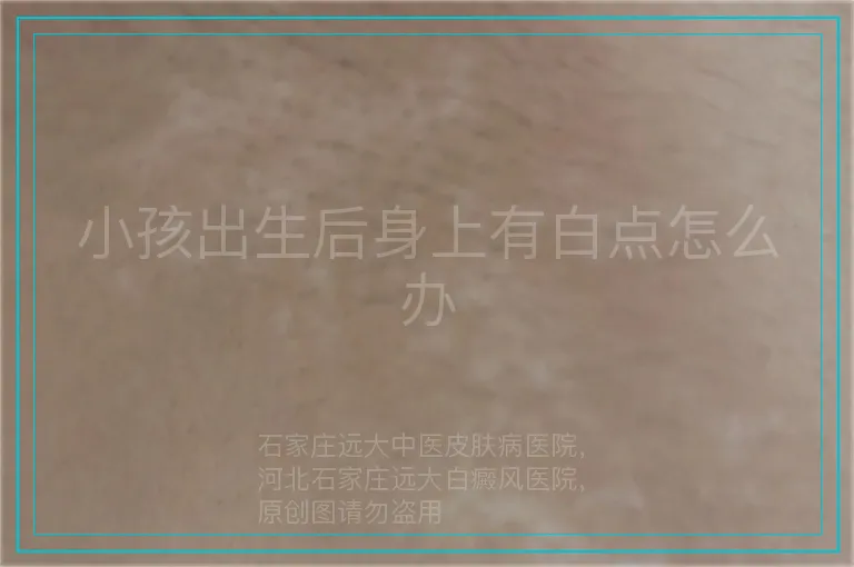 小孩出生后身上有白点怎么办