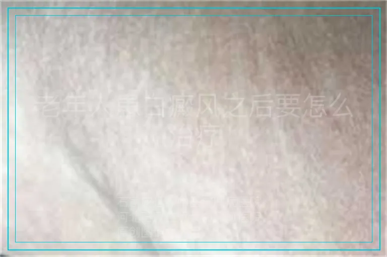 老年人患白癜风之后要怎么治疗