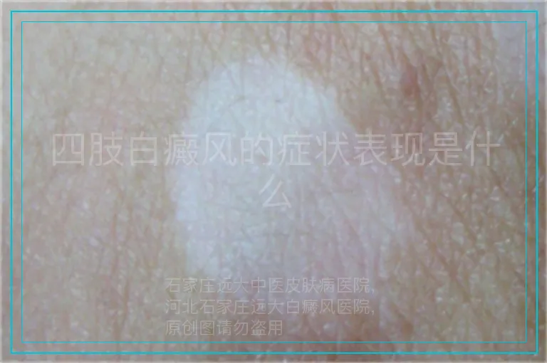 四肢白癜风的症状表现是什么