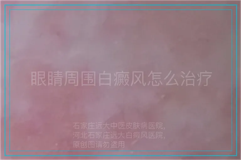 眼睛周围白癜风怎么治疗