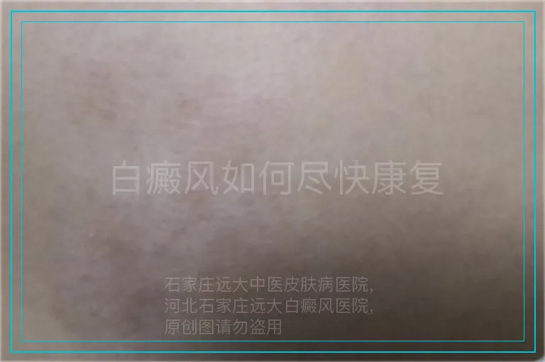 白癜风如何尽快康复