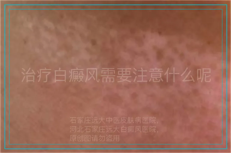 治疗白癜风需要注意什么呢