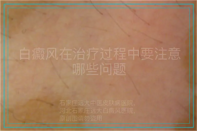 白癜风在治疗过程中要注意哪些问题
