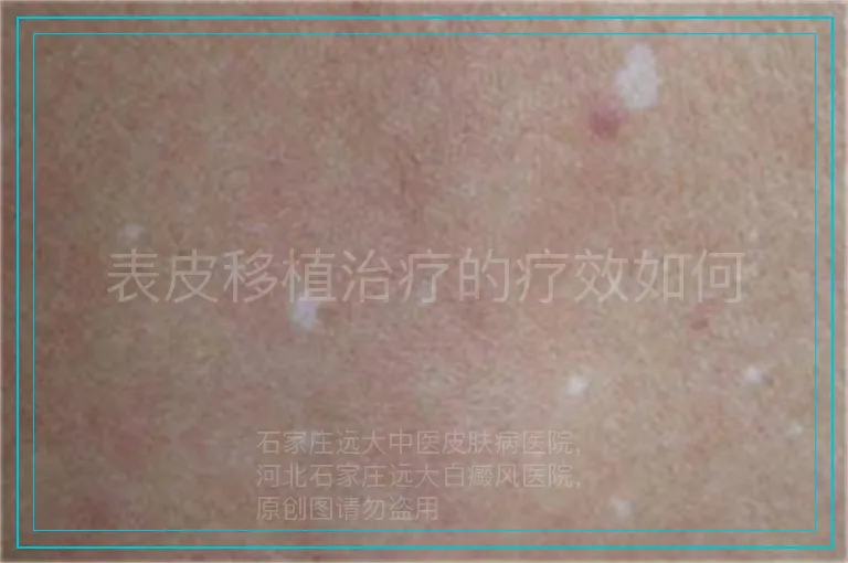表皮移植治疗的疗效如何