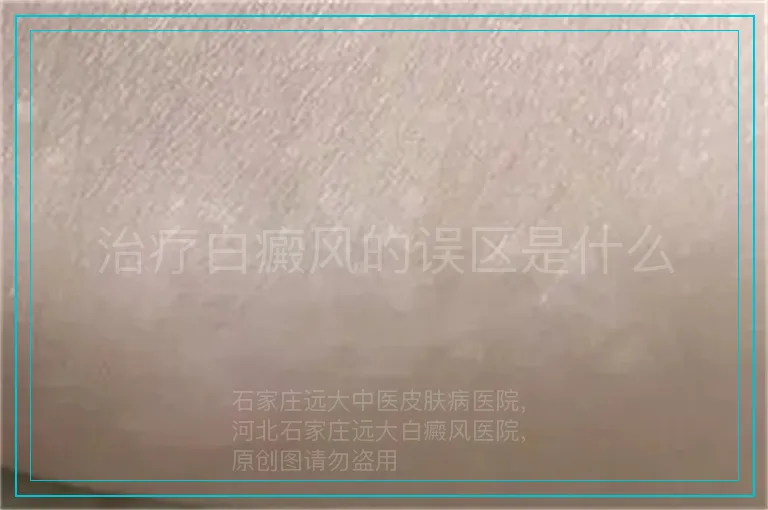治疗白癜风的误区是什么