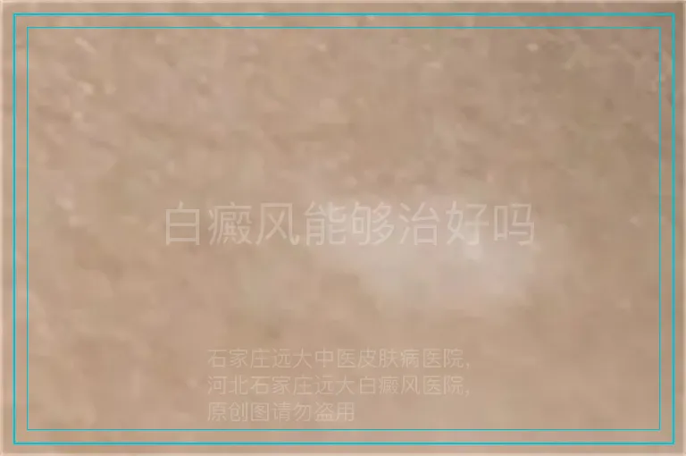 白癜风能够治好吗