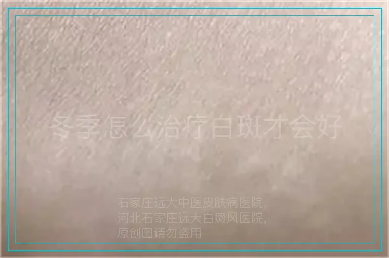 冬季怎么治疗白斑才会好
