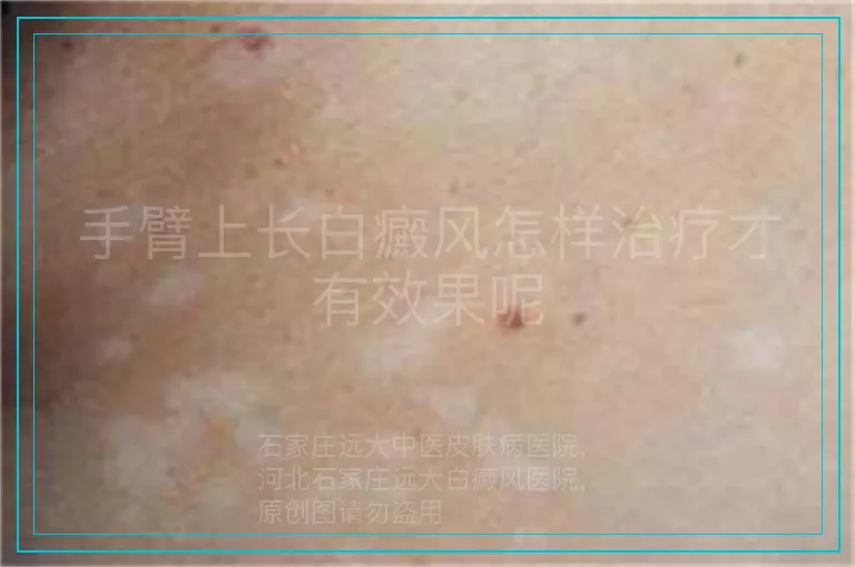 手臂上长白癜风怎样治疗才有效果呢