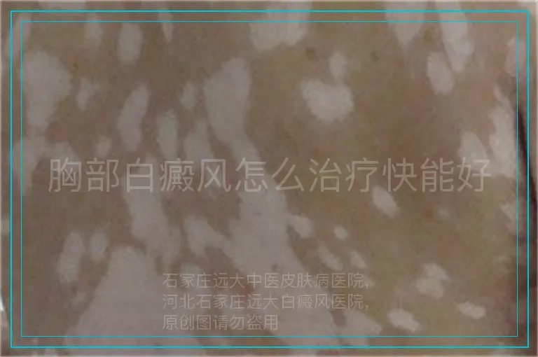 胸部白癜风怎么治疗快能好