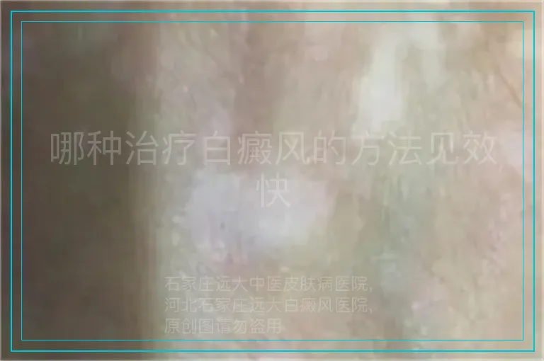 哪种治疗白癜风的方法见效快