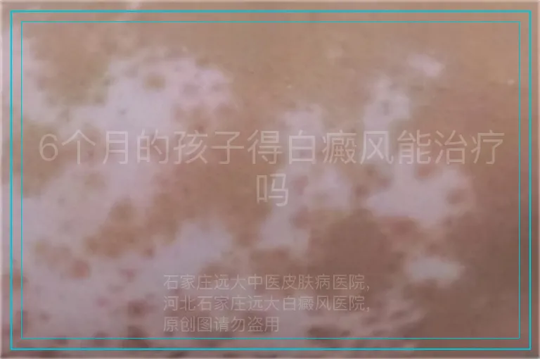 6个月的孩子得白癜风能治疗吗