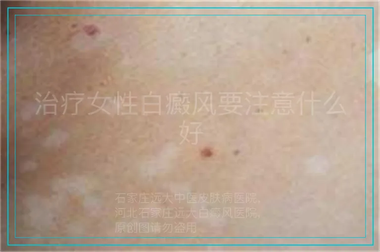 治疗女性白癜风要注意什么好