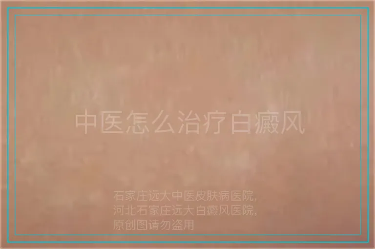 中医怎么治疗白癜风