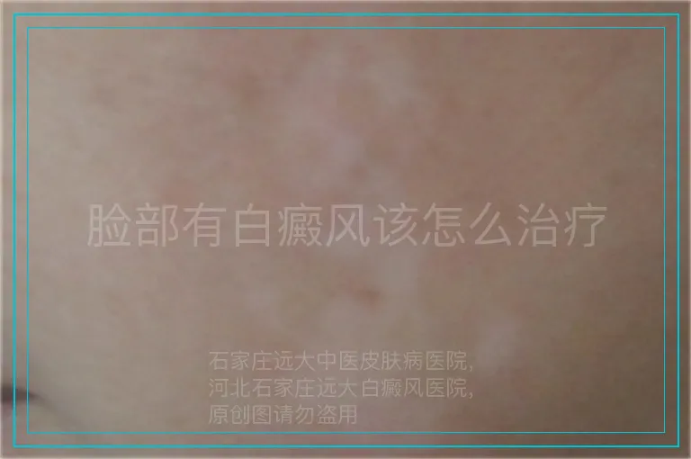 脸部有白癜风该怎么治疗