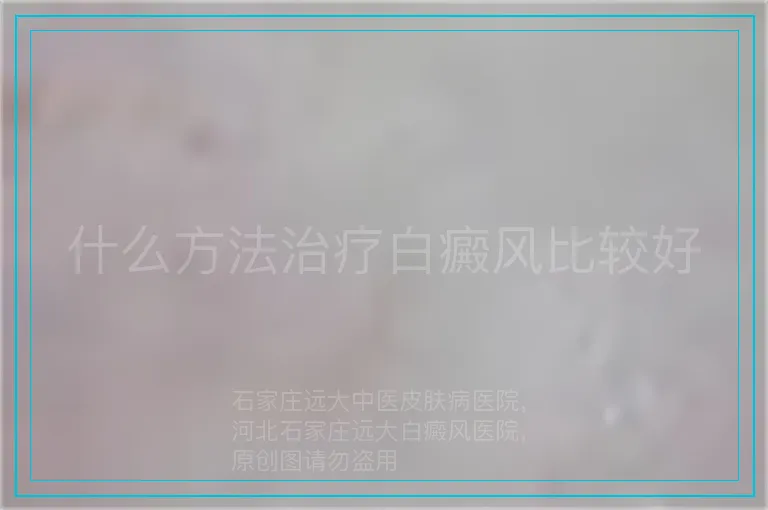 什么方法治疗白癜风比较好