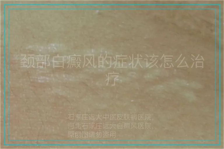 颈部白癜风的症状该怎么治疗