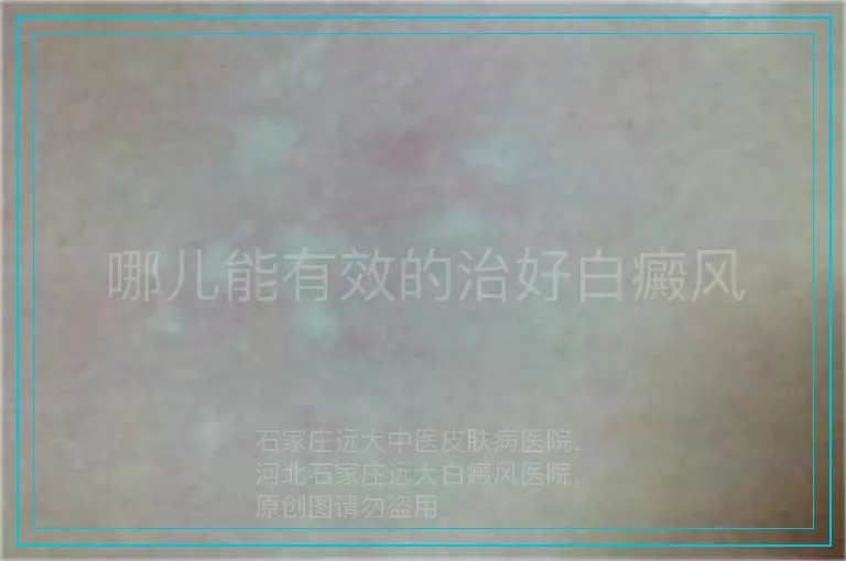 哪儿能有效的治好白癜风
