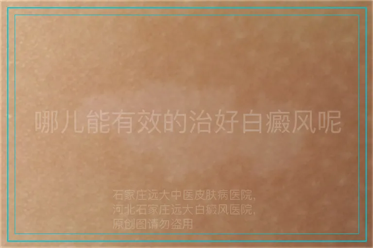 哪儿能有效的治好白癜风呢