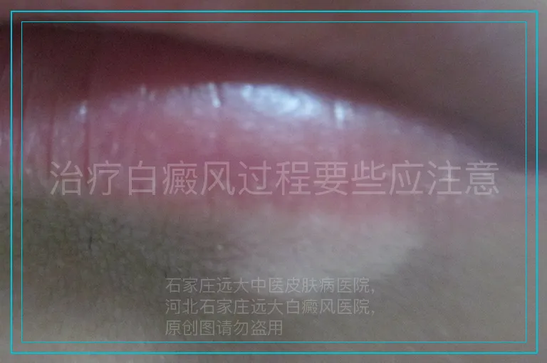 治疗白癜风过程要些应注意