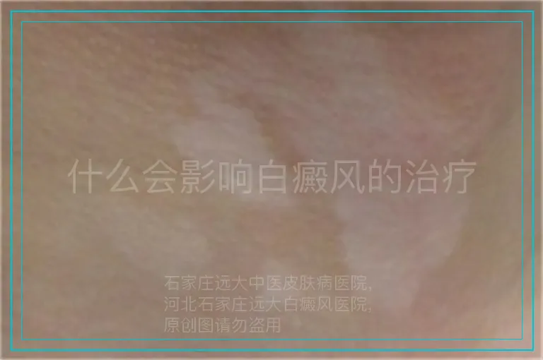 什么会影响白癜风的治疗