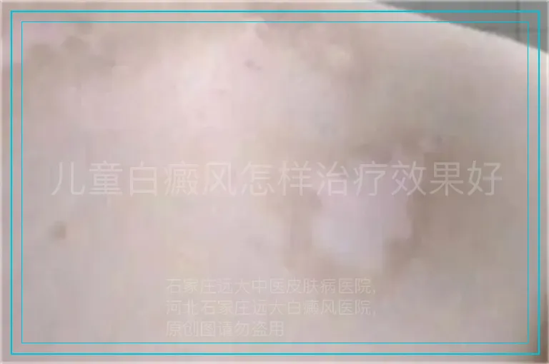 儿童白癜风怎样治疗效果好