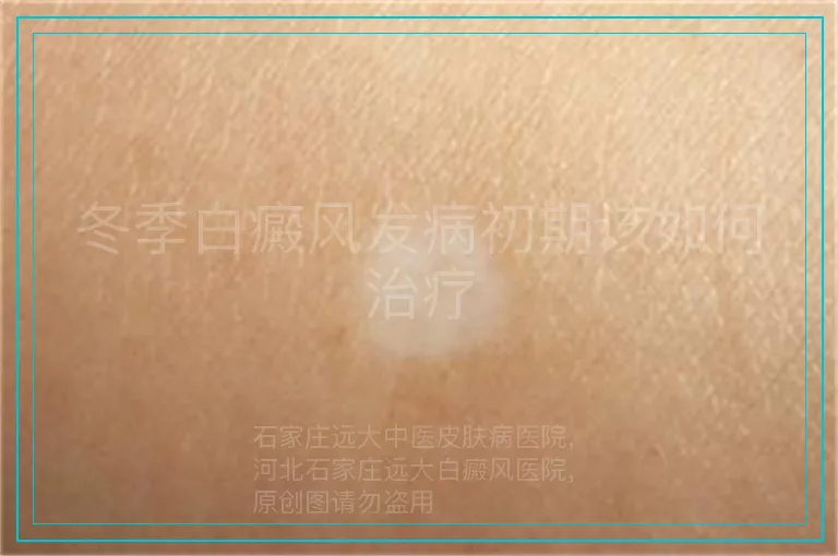 冬季白癜风发病初期该如何治疗