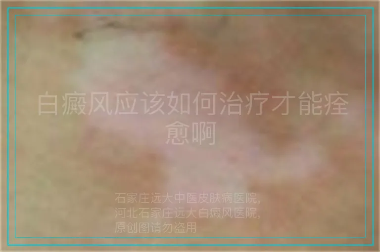 白癜风应该如何治疗才能痊愈啊