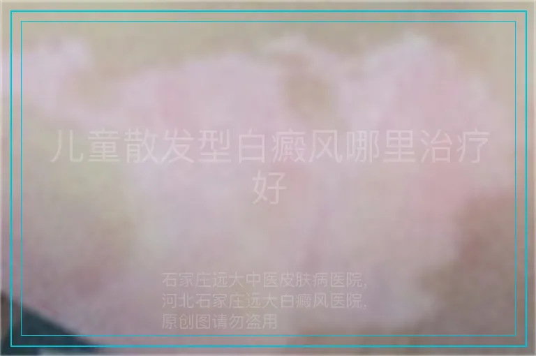 儿童散发型白癜风哪里治疗好